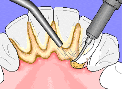 Periodontal Disease, Scaling and Root Planing, Deep Cleaning, Gingivitis, Bone Loss, Tooth Cavity, Gum Bleeding, Tempe, Chandler, Mesa, Phoenix, Gilbert, Arizona