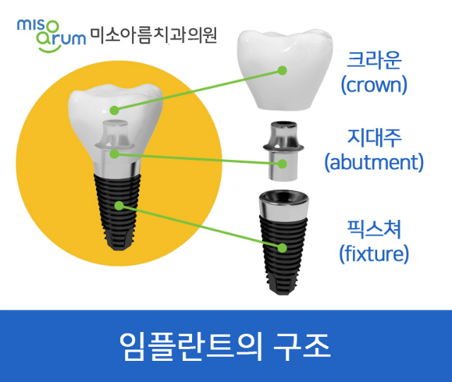 전주임플란트치과 빠진 치아를 방치할 경우 나타나는 문제점