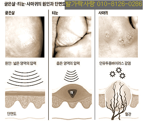 티눈엔 발가락 운동용구 듀트